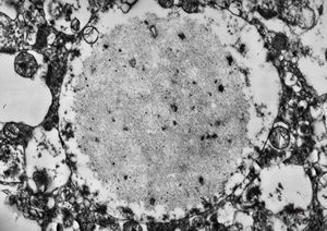 M,71y. | Alzheimer diseaseaccompanied with CADASIL - amyloid body